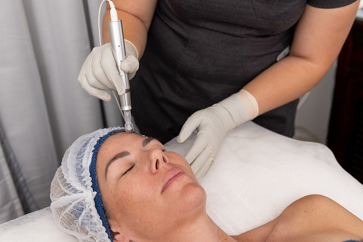 Skin-Needling1