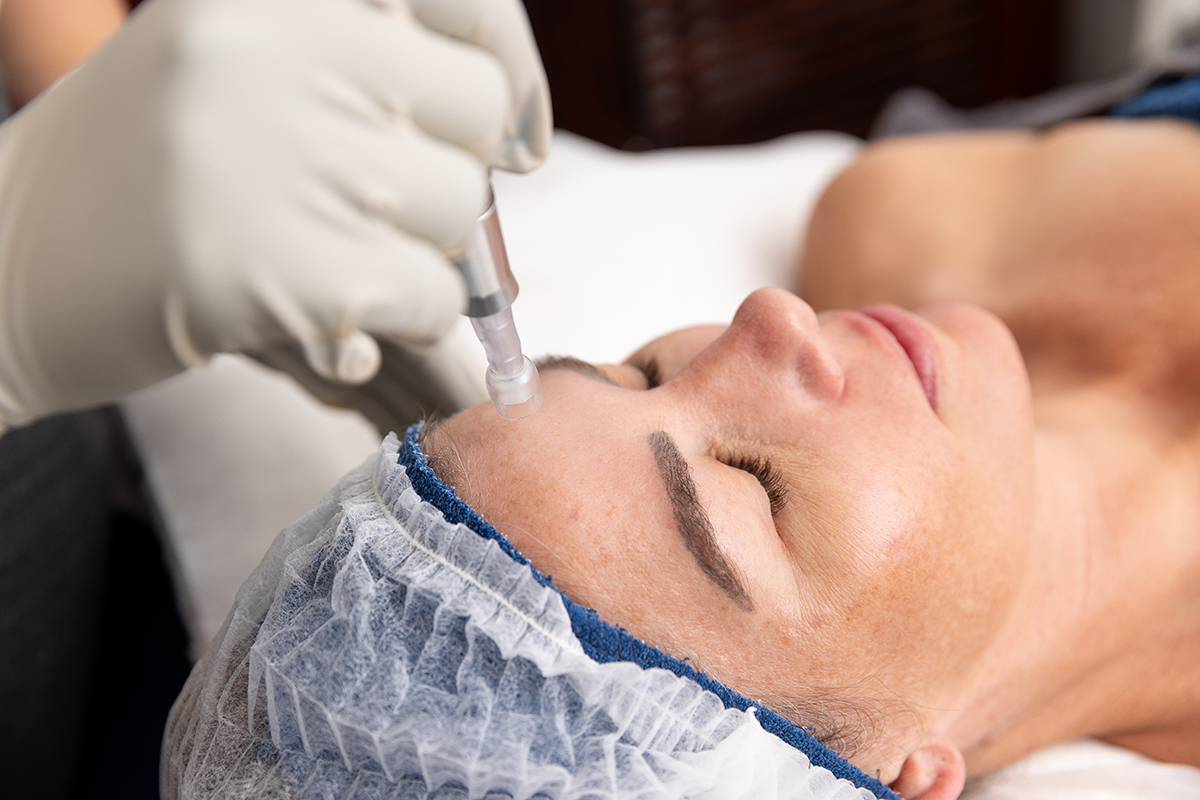 Skin-Needling3